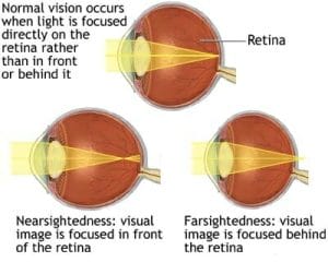Nearsighted vs. Farsighted